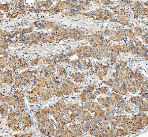 LAMP1 Antibody Human Liver Cancer IHC. Immunohistochemical staining of FFPE human liver cancer tissue using LAMP1 Antibody / Lysosomal Membrane Glycoprotein Antibody following heat-induced epitope retrieval in pH8 EDTA buffer. The antibody was applied at 2 ug/ml and detected using an HRP-conjugated secondary antibody with DAB chromogen. Strong granular cytoplasmic staining is observed throughout the malignant hepatocytes, consistent with abundant lysosomal localization, while the surrounding stromal tissue exhibits comparatively weaker immunoreactivity. This LAMP1 Antibody is suitable for investigating lysosomal membrane biology, intracellular trafficking, autophagy, and liver cancer progression.