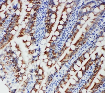 IHC-P: FER antibody testing of human intestinal cancer tissue. HIER: steamed with pH6 citrate buffer.