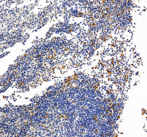 CSF1R Antibody IHC in Human Breast Cancer. Immunohistochemistry of FFPE human breast cancer tissue was performed with CSF1R Antibody at 2 ug/ml following heat-induced epitope retrieval in pH 8 EDTA buffer. Scattered cells show distinct brown cytoplasmic and membranous staining among largely negative tumor and stromal cell populations. The restricted staining pattern supports detection with an M-CSF Receptor Antibody in human breast cancer tissue.