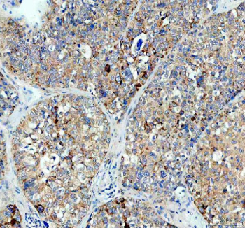 Immunohistochemical staining of FFPE human liver cancer tissue with MALT1 antibody, HRP-secondary and DAB substrate. HIER: boil tissue sections in pH8 EDTA for 20 min and allow to cool before testing.