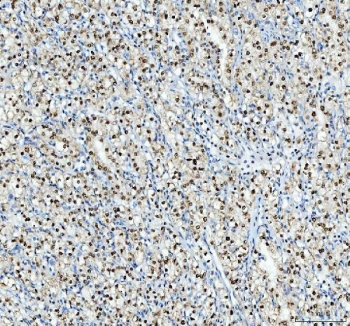 IHC staining of FFPE human glioma tissue with Nucleophosmin antibody. HIER: boil tissue sections in pH8 EDTA for 20 min and allow to cool before testing.