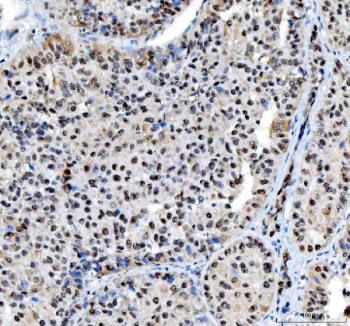 IHC staining of FFPE human liver cancer tissue with Nucleophosmin antibody. HIER: boil tissue sections in pH8 EDTA for 20 min and allow to cool before testing.