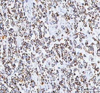 IHC staining of FFPE human breast cancer tissue with TFAM antibody. HIER: boil tissue sections in pH8 EDTA for 20 min and allow to cool before testing.