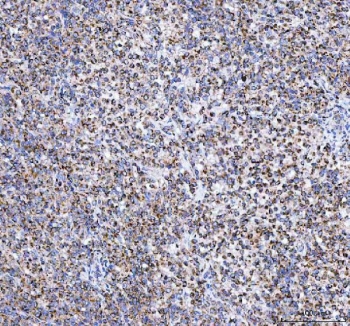 IHC staining of FFPE human intestinal diffuse large B-cell lymphoma tissue with TFAM antibody. HIER: boil tissue sections in pH8 EDTA for 20 min and allow to cool before testing.