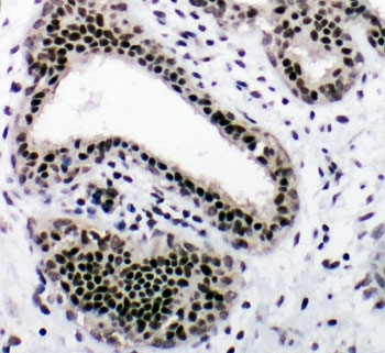 IHC-P: NRF1 antibody testing of human breast cancer tissue