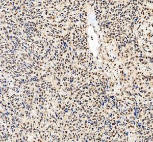 DNA-PKcs Antibody Human Ovarian Cancer IHC. Immunohistochemical staining of FFPE human ovarian cancer tissue using DNA-PKcs antibody. Heat-induced epitope retrieval was performed in pH 8.0 EDTA buffer before incubation with DNA-PKcs antibody at 2 ug/ml. An HRP-conjugated secondary antibody with DAB chromogen was used for visualization. Tumor cells display strong nuclear staining with weaker cytoplasmic staining, consistent with the established role of DNA-PKcs in nuclear DNA damage repair and genome maintenance. This DNA-PKcs Antibody, also called PRKDC Antibody, is suitable for studies of DNA damage repair, non-homologous end joining, genome stability, and DNA repair signaling.