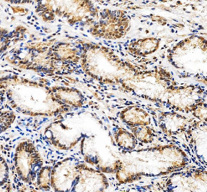 DNA-PKcs Antibody Human Gastric Carcinoma IHC. Immunohistochemical staining of FFPE human gastric carcinoma tissue using DNA-PKcs antibody. Heat-induced epitope retrieval was performed in pH 8.0 EDTA buffer before incubation with DNA-PKcs antibody at 2 ug/ml. An HRP-conjugated secondary antibody with DAB chromogen was used for visualization. Tumor cells show predominantly nuclear staining with weaker cytoplasmic staining, consistent with the known localization and function of DNA-PKcs in DNA damage repair. This DNA-PKcs Antibody, also called PRKDC Antibody, is suitable for studies of DNA damage repair, non-homologous end joining, genome stability, and DNA repair signaling.