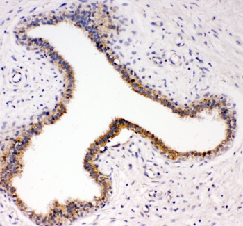 IHC-P: TrkC antibody testing of human breast cancer tissue