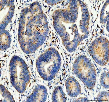 Flotillin 1 Antibody Human Stomach Cancer IHC. IHC staining of FFPE human stomach cancer tissue with Flotillin 1 Antibody. HIER was performed by boiling tissue sections in pH 8 EDTA buffer for 20 minutes, followed by cooling prior to staining. The section was incubated with Flotillin 1 antibody, followed by detection using HRP-secondary and DAB chromogen. Flotillin 1 Antibody / Lipid Raft Marker Antibody demonstrates membrane and cytoplasmic staining consistent with FLOT1 expression and supports studies of lipid raft organization, membrane microdomains and cell signaling pathways.
