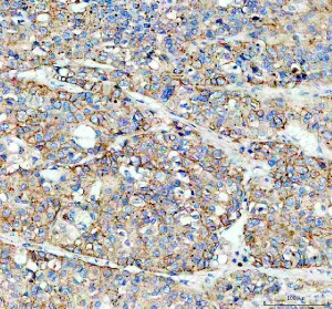 Flotillin 1 Antibody Human Liver Cancer IHC High Magnification. IHC staining of FFPE human liver cancer tissue with Flotillin 1 Antibody at 2 ug/ml. HIER was performed using pH 8 EDTA buffer, followed by blocking with 10% goat serum. The tissue section was incubated with rabbit anti-FLOT1 antibody overnight at 4Â°C, followed by HRP-conjugated goat anti-rabbit IgG secondary antibody and DAB chromogen detection. Flotillin 1 Antibody / Lipid Raft Marker Antibody demonstrates membrane and cytoplasmic staining consistent with FLOT1 expression and supports research into lipid raft organization, membrane-associated signaling and cancer cell biology pathways.