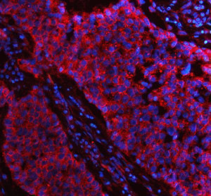 Flotillin 1 Antibody Human Lung Cancer IF. Immunofluorescent staining of FFPE human non-small cell lung cancer tissue with Flotillin 1 Antibody at 5 ug/ml. HIER was performed using pH 8 EDTA buffer, followed by blocking with 10% goat serum. The tissue section was incubated with rabbit anti-FLOT1 antibody overnight at 4Â°C, followed by Cy3 conjugated goat anti-rabbit IgG secondary antibody (red). Nuclei were counterstained with DAPI (blue). Flotillin 1 Antibody / Lipid Raft Marker Antibody demonstrates membrane and cytoplasmic staining consistent with FLOT1 expression and supports studies of membrane microdomains, lipid raft biology and cancer cell signaling pathways.