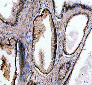 Flotillin 1 Antibody Human Thyroid Cancer IHC. IHC staining of FFPE human thyroid cancer tissue with Flotillin 1 Antibody at 2 ug/ml. HIER was performed using pH 8 EDTA buffer, followed by blocking with 10% goat serum. The tissue section was incubated with rabbit anti-FLOT1 antibody overnight at 4Â°C, followed by HRP-conjugated goat anti-rabbit IgG secondary antibody and DAB chromogen detection. Flotillin 1 Antibody / Lipid Raft Marker Antibody demonstrates membrane and cytoplasmic staining consistent with FLOT1 expression and supports studies of lipid raft organization, membrane microdomains and cell signaling pathways.