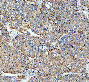 Flotillin 1 Antibody Human Liver Cancer IHC. IHC staining of FFPE human liver cancer tissue with Flotillin 1 Antibody at 2 ug/ml. HIER was performed using pH 8 EDTA buffer, followed by blocking with 10% goat serum. The tissue section was incubated with rabbit anti-FLOT1 antibody overnight at 4Â°C, followed by HRP-conjugated goat anti-rabbit IgG secondary antibody and DAB chromogen detection. Flotillin 1 Antibody / Lipid Raft Marker Antibody demonstrates membrane and cytoplasmic staining consistent with FLOT1 expression and supports studies of lipid raft organization, membrane microdomains, vesicle trafficking and cancer cell signaling pathways.