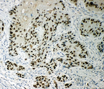 p63 Antibody Esophageal Squamous Cell Carcinoma IHC. Immunohistochemistry testing of p63 antibody and FFPE human esophageal squamous cell carcinoma tissue.