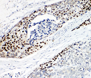 p63 Antibody Human Esophageal Squamous Cell Carcinoma Tissue IHC. Immunohistochemistry testing of p63 antibody and FFPE human esophageal squamous cell carcinoma tissue.