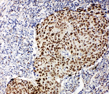 p63 Antibody Lung Cancer IHC. Immunohistochemistry testing of p63 antibody and human lung cancer tissue.