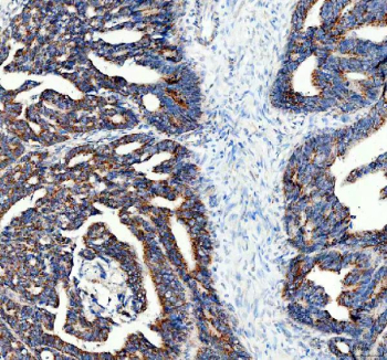 Immunohistochemical staining of FFPE human colon cancer tissue with PMP70 antibody, HRP-secondary and DAB substrate. HIER: boil tissue sections in pH8 EDTA for 20 min and allow to cool before testing.