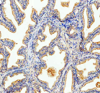 Immunohistochemical staining of FFPE human prostate cancer tissue with PMP70 antibody, HRP-secondary and DAB substrate. HIER: boil tissue sections in pH8 EDTA for 20 min and allow to cool before testing.