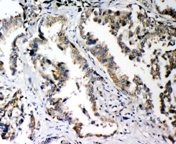 IHC-P: PLK2 antibody testing of human lung cancer tissue. HIER: steam section in pH6 citrate buffer for 20 min and allow to cool prior to staining.