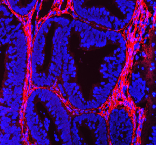 Collagen 1 Antibody for IF / COL1A1 Immunofluorescence Antibody Human Endometrial Cancer IF. Immunofluorescent staining of FFPE human endometrial cancer tissue using Collagen 1 Antibody for IF / COL1A1 Immunofluorescence Antibody. Collagen I is detected predominantly within the extracellular matrix surrounding tumor glands, consistent with its role as a major structural component of the stromal microenvironment. Heat-induced epitope retrieval was performed in pH 8.0 EDTA buffer prior to staining. Tissue sections were blocked with 10% goat serum and incubated with the primary antibody (5 ug/ml) overnight at 4Â°C, followed by Fluoro550-conjugated goat anti-rabbit IgG. Nuclei were counterstained with DAPI and fluorescence was visualized using appropriate filter sets.