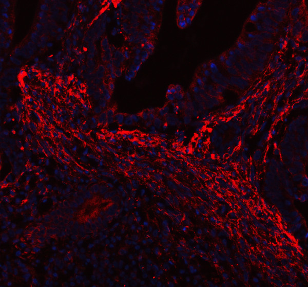 Collagen 1 Antibody for IF / COL1A1 Immunofluorescence Antibody Human Intestinal Cancer IF. Immunofluorescent staining of FFPE human intestinal cancer tissue using Collagen 1 Antibody for IF / COL1A1 Immunofluorescence Antibody. Collagen I is detected predominantly within the desmoplastic stromal extracellular matrix surrounding malignant glands, consistent with its role in maintaining tumor architecture and supporting the tumor microenvironment. Heat-induced epitope retrieval was performed in pH 8.0 EDTA buffer prior to staining. Tissue sections were blocked with 10% goat serum and incubated with the primary antibody (5 ug/ml) overnight at 4Â°C, followed by Cy3-conjugated goat anti-rabbit IgG. Nuclei were counterstained with DAPI and fluorescence was visualized using appropriate filter sets.