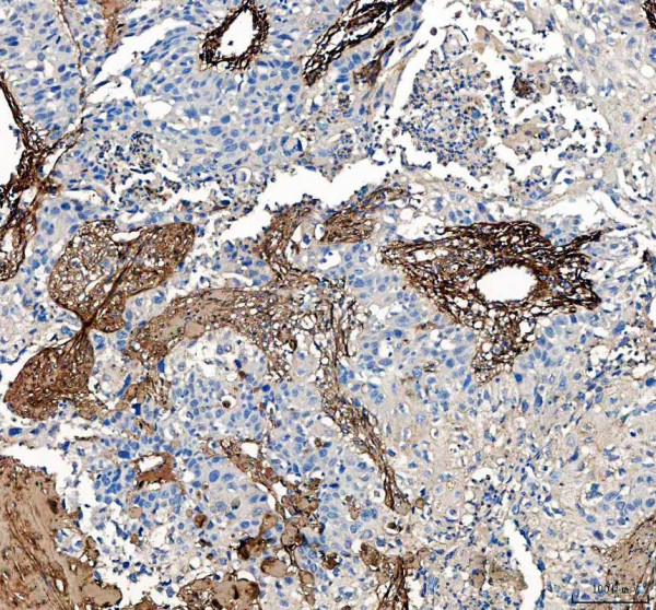 Collagen 1 Antibody Renal Cell Carcinoma IHC. Immunohistochemistry analysis of Collagen I / COL1A1 expression in FFPE human renal cell carcinoma tissue using Collagen 1 antibody. HRP-DAB brown staining highlights extracellular collagen fibers outlining tumor-associated stroma and vascular structures, forming a delicate network surrounding nests of tumor cells, while tumor cells show minimal intracellular staining; nuclei are counterstained blue. Antigen retrieval was performed by boiling sections in pH 8 EDTA buffer for 20 min followed by cooling prior to staining.