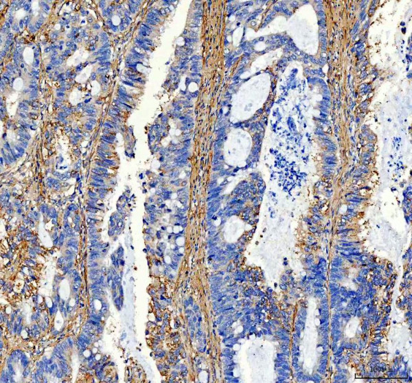Collagen 1 Antibody / COL1A1 Extracellular Matrix Antibody Human Rectal Adenocarcinoma IHC. Immunohistochemical staining of FFPE human rectal adenocarcinoma tissue using Collagen 1 Antibody / COL1A1 Extracellular Matrix Antibody. Collagen I is detected predominantly within the stromal extracellular matrix surrounding malignant glands, consistent with its role in maintaining tissue architecture and contributing to the desmoplastic tumor microenvironment. Heat-induced epitope retrieval was performed in pH 8.0 EDTA buffer prior to staining. Tissue sections were blocked with 10% goat serum and incubated with the primary antibody (2 ug/ml) overnight at 4Â°C, followed by a peroxidase-conjugated goat anti-rabbit IgG secondary antibody. Immunoreactivity was visualized using an HRP Super Vision detection system with DAB as the chromogen.