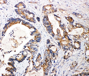 IHC-P: FGFR3 antibody testing of human intestine cancer tissue