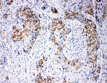 IHC-P: beta Arrestin 1 antibody testing of human breast cancer tissue