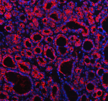 Immunofluorescent staining of FFPE human thyroid cancer tissue with Profilin 2 antibody (red) and DAPI nuclear stain (blue). HIER: steam section in pH8 EDTA buffer for 20 min.