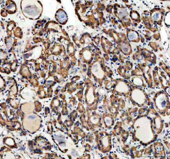 Immunohistochemical staining of FFPE human thyroid cancer tissue with Profilin 2 antibody, HRP-secondary and DAB substrate. HIER: boil tissue sections in pH8 EDTA for 20 min and allow to cool before testing.