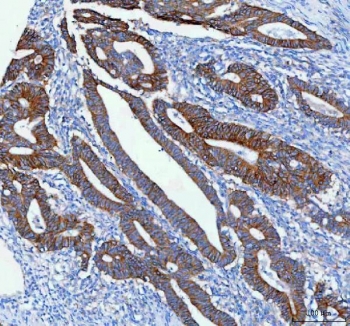IHC staining of FFPE human colorectal adenocarcinoma tissue with NKCC1 antibody. HIER: boil tissue sections in pH8 EDTA for 20 min and allow to cool before testing.
