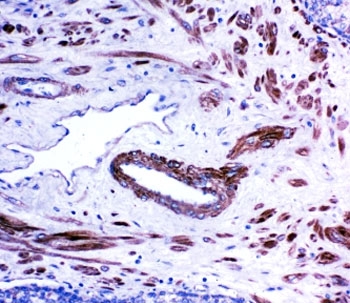 ACE Antibody Prostate Cancer Immunohistochemistry. IHC-P: ACE antibody testing of human prostate cancer tissue.
