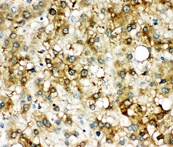 SERPINA3 Antibody Liver Cancer IHC. Immunohistochemistry staining of human liver cancer tissue with SERPINA3 antibody.