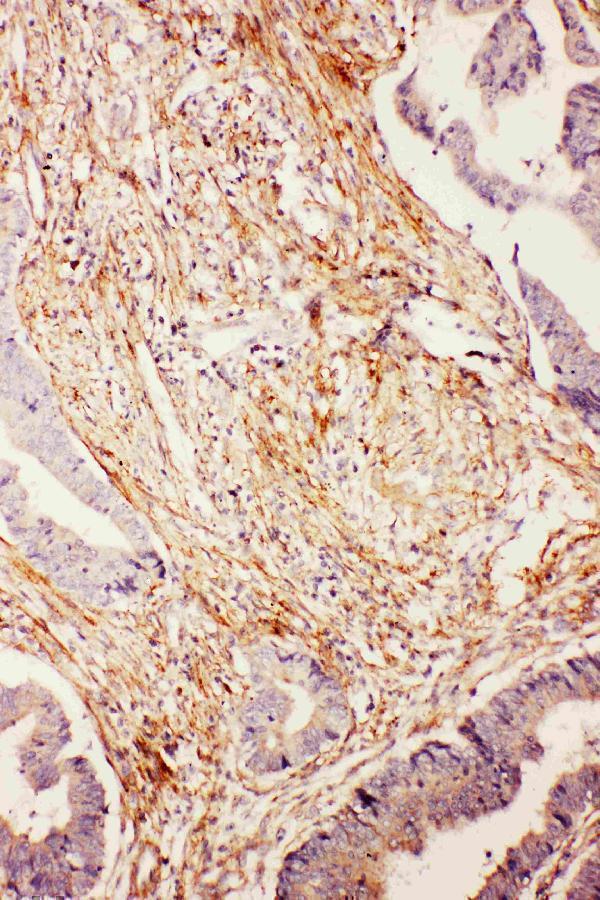 UBD Antibody Human Intestinal Cancer IHC. IHC staining of FFPE human intestinal cancer tissue with UBD antibody demonstrated moderate to strong cytoplasmic staining within malignant cells and adjacent stromal components, consistent with the expression pattern of UBD (Ubiquitin D), also known as FAT10. UBD is a ubiquitin-like modifier that targets proteins for proteasomal degradation and is induced by pro-inflammatory cytokines including interferon-g and TNF-a. Increased UBD expression has been reported in gastrointestinal malignancies, where it has been associated with inflammation, altered protein homeostasis, and tumor progression. The observed staining supports the utility of UBD Antibody for studies of ubiquitin-like protein conjugation, proteasomal degradation, immune signaling, and cancer biology. Immunohistochemistry was performed on formalin-fixed, paraffin-embedded human intestinal cancer tissue.