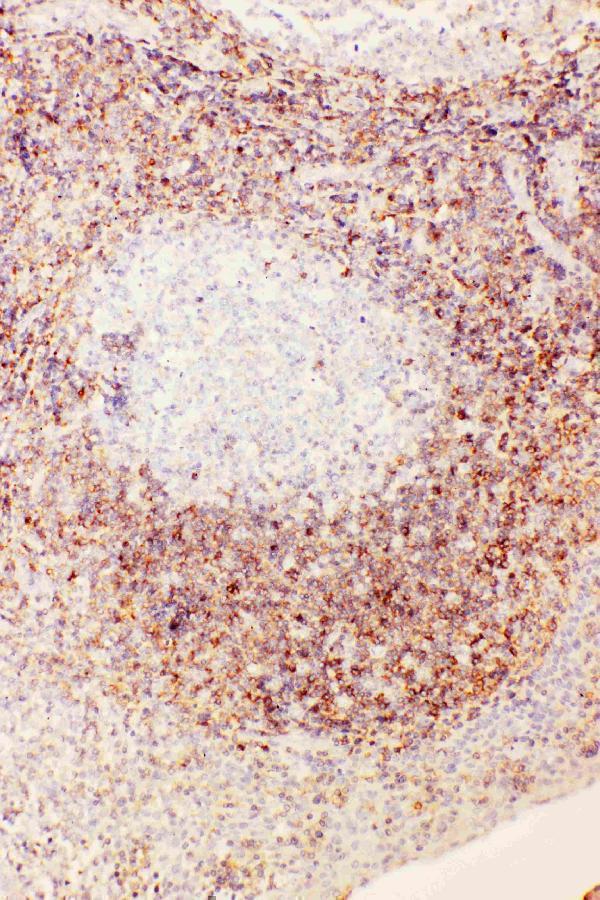 UBD Antibody Human Tonsil IHC. IHC staining of FFPE human tonsil tissue with UBD antibody demonstrated prominent cytoplasmic staining in lymphoid cells within the tonsillar follicles and surrounding immune cell populations, consistent with the expression pattern of UBD (Ubiquitin D), also known as FAT10. UBD is a ubiquitin-like modifier that is strongly induced by the pro-inflammatory cytokines interferon-g and TNF-a and plays important roles in proteasomal degradation, antigen processing, and immune regulation. The abundant staining observed in this lymphoid tissue is consistent with the established role of UBD in activated immune cells and inflammatory responses. These results support the utility of UBD Antibody for studies of ubiquitin-like protein conjugation, immune signaling, inflammation, and lymphoid tissue biology. Immunohistochemistry was performed on formalin-fixed, paraffin-embedded human tonsil tissue.