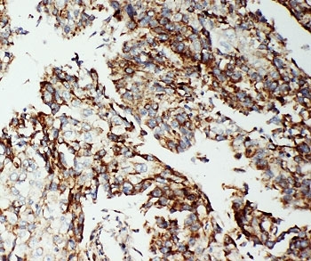 IHC-P: Apoptosis-Inducing Factor antibody testing of human lung cancer tissue
