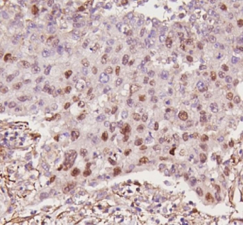 IHC staining of FFPE human lung cancer tissue with p53 antibody. HIER: boil tissue sections in pH8 EDTA for 20 min and allow to cool before testing.