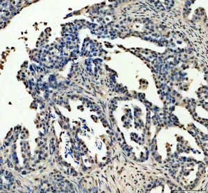 p53 Antibody for IP Human Ovarian Cancer IHC. Immunohistochemistry staining of FFPE human ovarian cancer tissue was performed with p53 Antibody for IP, also called Tumor Protein p53 Immunoprecipitation Antibody. Heat-induced epitope retrieval was performed in EDTA buffer, pH 8.0. The antibody was used at 2 ug/ml overnight at 4oC, followed by an HRP-conjugated secondary antibody and DAB detection. Positive nuclear staining is observed in populations of tumor epithelial cells. This p53 Antibody demonstrates detection of endogenous TP53 in human ovarian cancer and complements its validated use for immunoprecipitation.