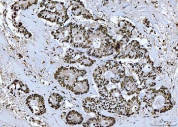 BRCA1 Antibody Colorectal Adenocarcinoma IHC. Immunohistochemistry staining of FFPE human colorectal adenocarcinoma tissue with BRCA1 antibody. HIER: boil tissue sections in pH8 EDTA for 20 min and allow to cool before testing.