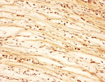 IHC-P: AKT2 antibody testing of human intestine cancer tissue