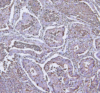 IHC staining of FFPE human colon cancer tissue with Annexin V antibody, HRP-labeled secondary and DAB substrate. HIER: boil tissue sections in pH8 EDTA for 20 min and allow to cool before testing.