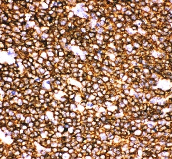 IHC staining of FFPE human tonsil with CD20 antibody. HIER: boil tissue sections in pH6, 10mM citrate buffer, for 10-20 min and allow to cool before testing.