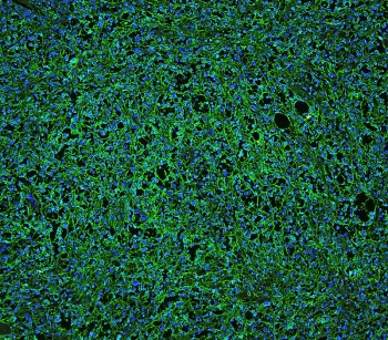 Immunofluorescent staining of FFPE human B lymphocytic tumor tissue with CD20 antibody (green) at 1ug/ml and DAPI nuclear stain (blue). HIER: boil tissue sections in pH6, 10mM citrate buffer, for 10-20 min and allow to cool before testing.
