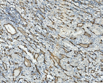 CD34 Antibody Glioma IHC. Immunohistochemistry analysis of CD34 expression in FFPE human glioma demonstrates prominent membranous HRP-DAB brown staining in tumor-associated vascular endothelial cells, highlighting dense and irregular microvascular proliferation within the tumor microenvironment, while neoplastic glial cells remain largely negative. The staining pattern emphasizes abnormal angiogenesis characteristic of glioma and supports identification of endothelial-lined vascular structures within tumor tissue. HIER: boil tissue sections in pH8 EDTA for 20 min and allow to cool before testing.