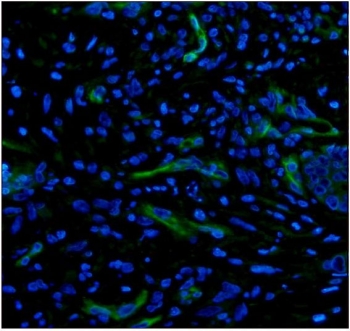 CD34 Antibody for IF. Immunofluorescence analysis of CD34 expression in FFPE human colon cancer using a CD34 Immunofluorescence Antibody reveals green membranous staining in tumor-associated vascular endothelial cells, highlighting irregular microvascular structures within the tumor stroma, while DAPI (blue) marks nuclei. The fluorescence pattern emphasizes endothelial cell localization and aberrant vascular architecture characteristic of tumor angiogenesis. HIER: boil tissue sections in pH8 EDTA for 20 min and allow to cool before testing.