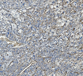 CD34 Antibody Liver Cancer IHC. Immunohistochemistry analysis of CD34 expression in FFPE human liver cancer demonstrates membranous HRP-DAB brown staining in tumor-associated vascular endothelial cells, highlighting sinusoid-like vascular channels and increased microvascular density within the tumor microenvironment, while surrounding hepatocellular tumor cells remain largely negative. The staining pattern emphasizes abnormal vascular remodeling and angiogenesis characteristic of liver cancer. HIER: boil tissue sections in pH8 EDTA for 20 min and allow to cool before testing.