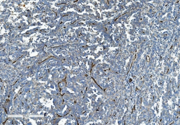 CD34 Antibody Ovarian Cancer IHC. Immunohistochemistry analysis of CD34 expression in FFPE human ovarian cancer shows membranous HRP-DAB brown staining in tumor-associated vascular endothelial cells, highlighting branching microvascular networks and stromal vessel structures within the tumor, while ovarian tumor cells remain largely negative. The staining pattern supports visualization of tumor angiogenesis and endothelial cell distribution in ovarian cancer tissue. HIER: boil tissue sections in pH8 EDTA for 20 min and allow to cool before testing.
