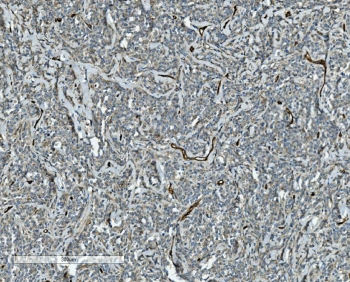 CD34 Antibody Lymphoma IHC. Immunohistochemistry analysis of CD34 expression in FFPE human lymphoma demonstrates membranous HRP-DAB brown staining in vascular endothelial cells within the tumor microenvironment, highlighting dispersed and irregular microvascular structures among lymphoid tumor cells, while lymphoma cells remain largely negative. The staining pattern supports visualization of tumor-associated vasculature and microvascular distribution in lymphoma tissue. HIER: boil tissue sections in pH8 EDTA for 20 min and allow to cool before testing.