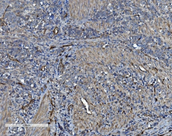 CD34 Antibody Gastric Cancer IHC. Immunohistochemistry analysis of CD34 expression in FFPE human gastric cancer demonstrates membranous HRP-DAB brown staining in tumor-associated vascular endothelial cells, highlighting irregular microvascular networks and stromal vessel structures within the tumor, while gastric epithelial tumor cells remain largely negative. The staining pattern emphasizes angiogenic remodeling and endothelial cell distribution characteristic of gastric cancer. HIER: boil tissue sections in pH8 EDTA for 20 min and allow to cool before testing.